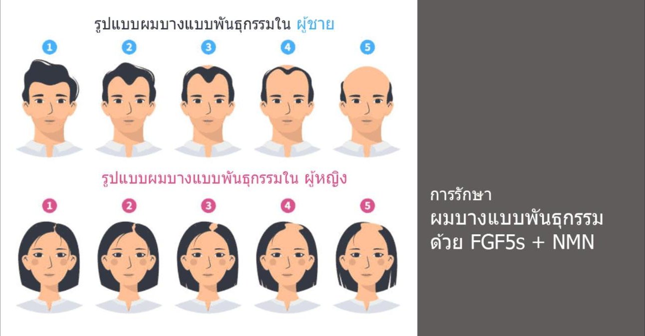 การรักษาผมบางด้วย FGF5s + NMN