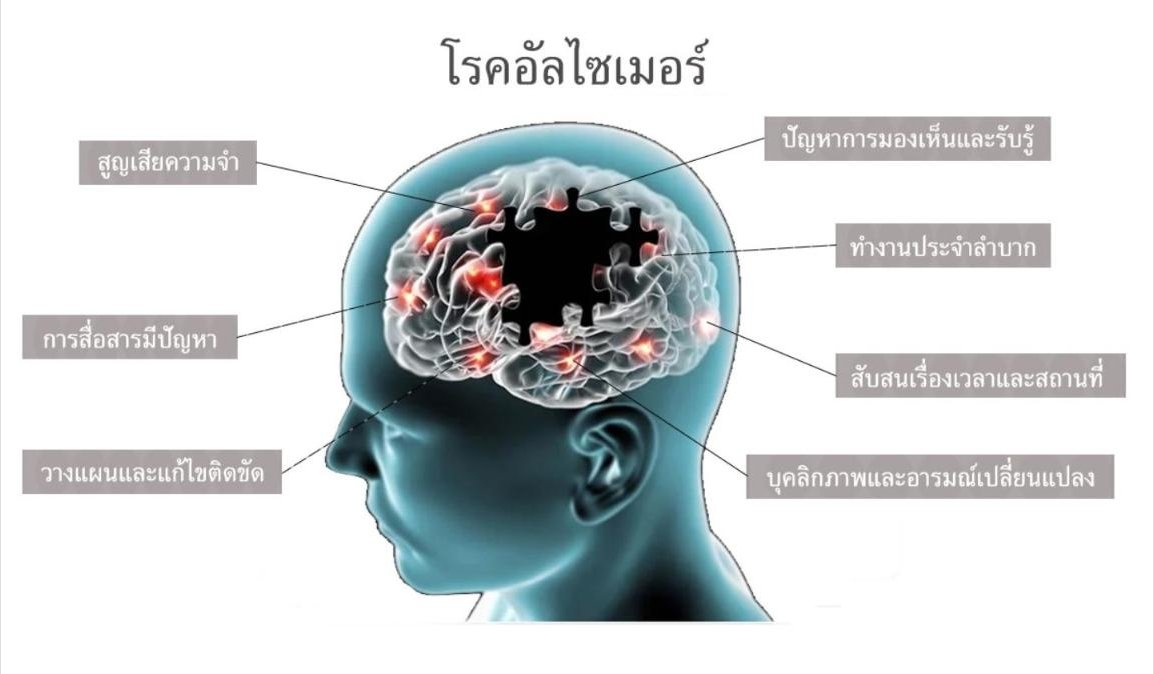 การรักษาโรคอัลไซเมอร์ด้วย NMN