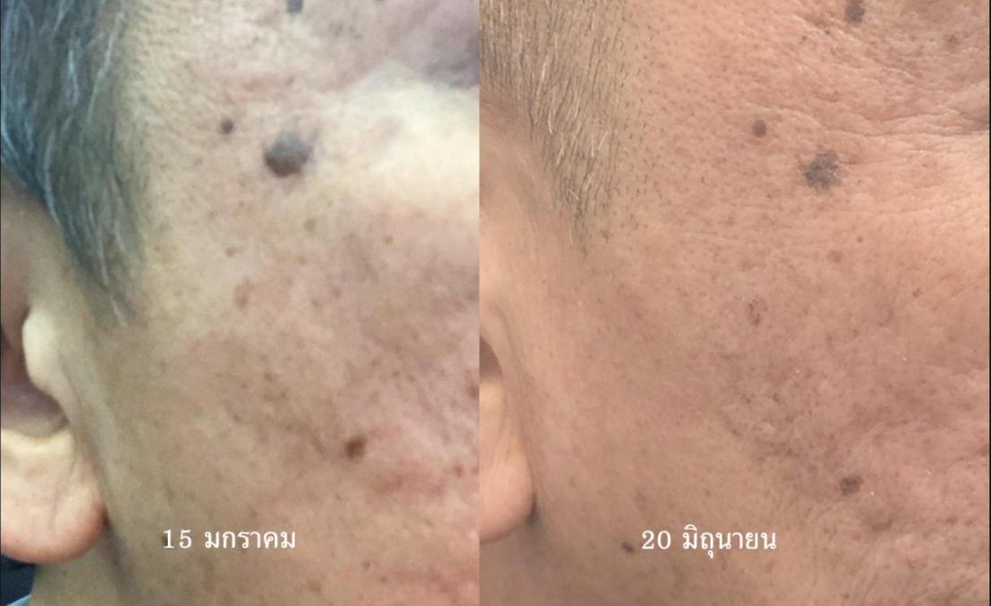 NMN + Resveratrol + Quercetin ทดลองด้วยตัวเอง